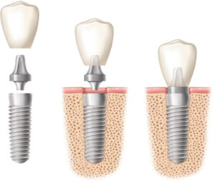 dental-implant-components